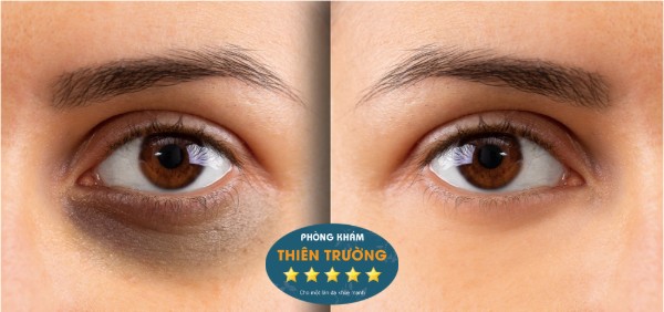 Hình ảnh: Thâm mắt.