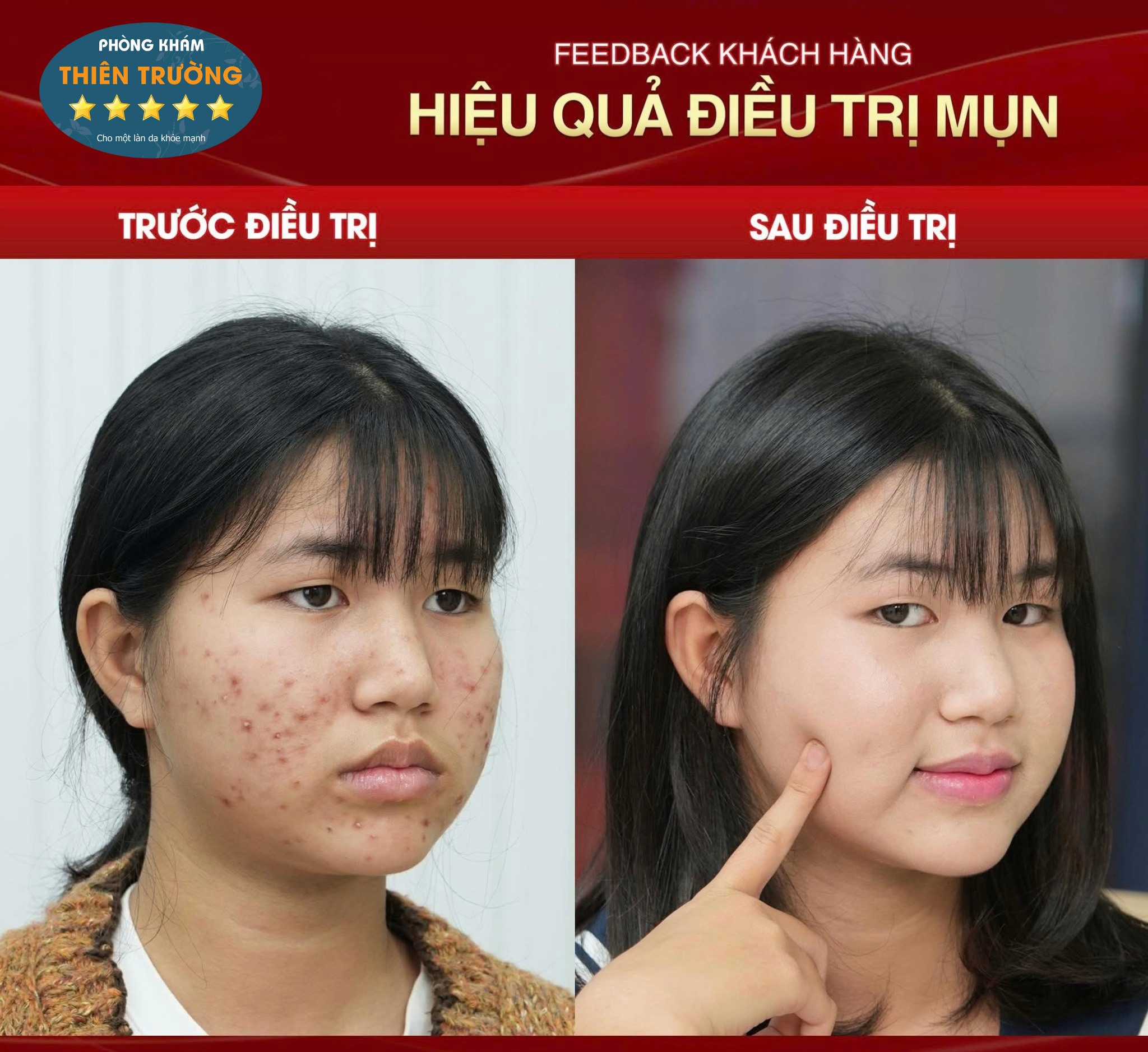 Hình ảnh: Trước và sau khi điều trị mụn