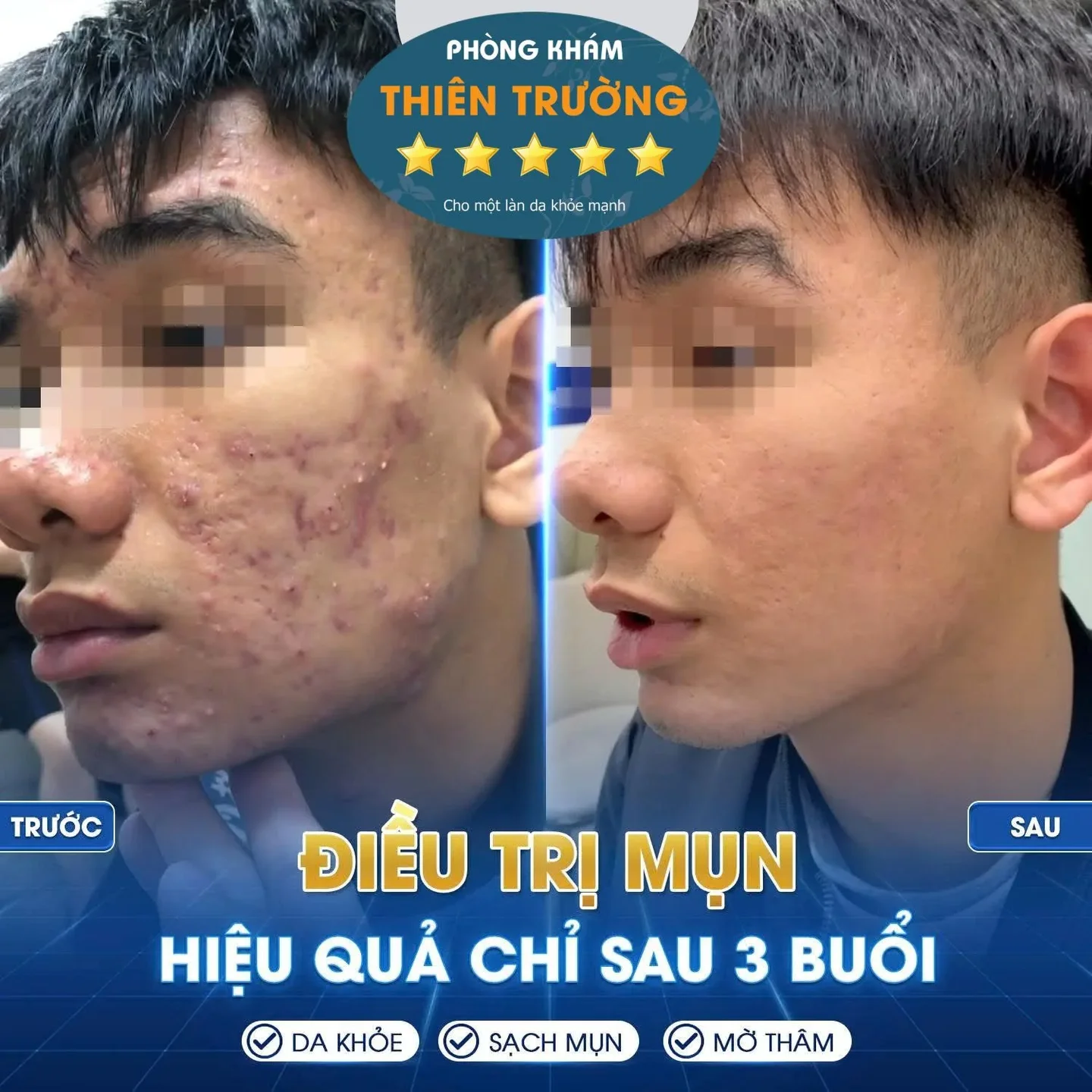 Hình ảnh: Mụn trứng cá
