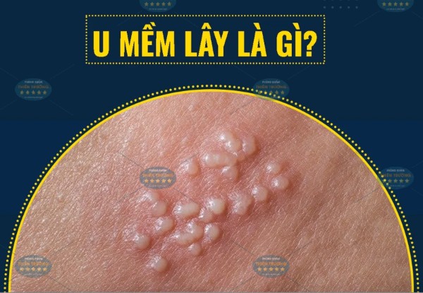 Hình ảnh : U mềm lây.