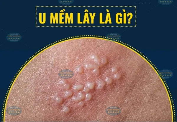 Hình ảnh : U mềm lây.